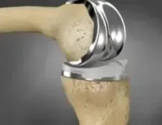 knee-replacement-implant