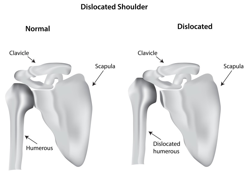 Sholder Dislocated