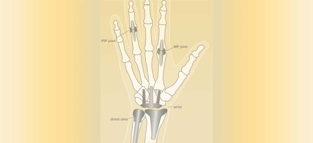 small joint of hand replacement