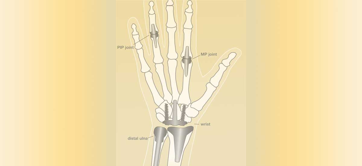 Joint Replacement Surgeon in Pune - Dr. Yash Shah