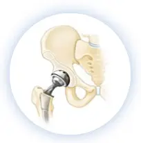 total hip replacement